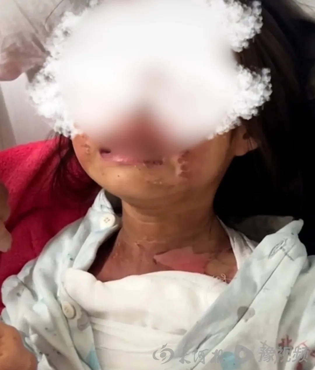 广东被高年级男生泼开水女童已返校，家长称多人被处理