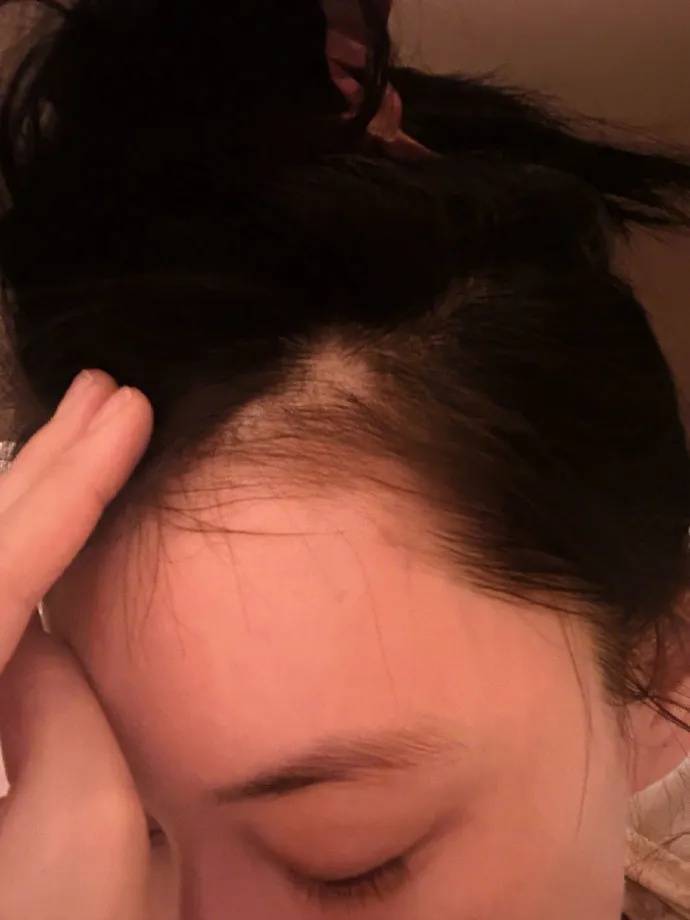 女星张馨予回应斑秃：好多了